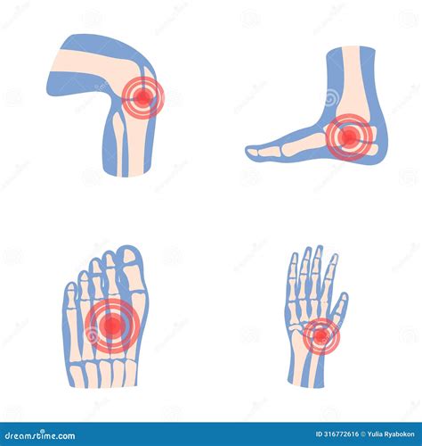 Arthritis Icons Set Cartoon Vector Human Joint With Pain Ring Stock