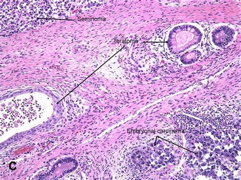 American Urological Association Mixed Germ Cell Tumor