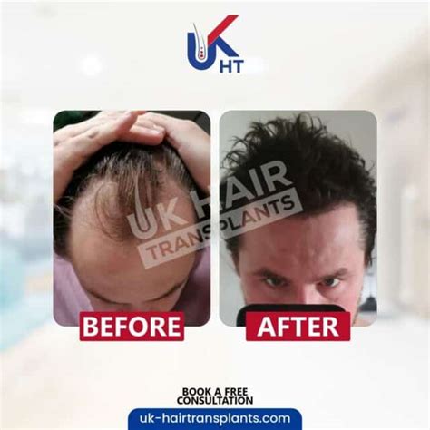 mens hair implants uk hair transplants  trusted choice