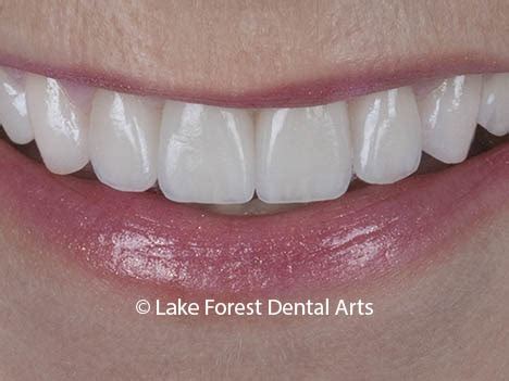 Porcelain Crowns-Types, Uses, Costs | Beautiful and Natural