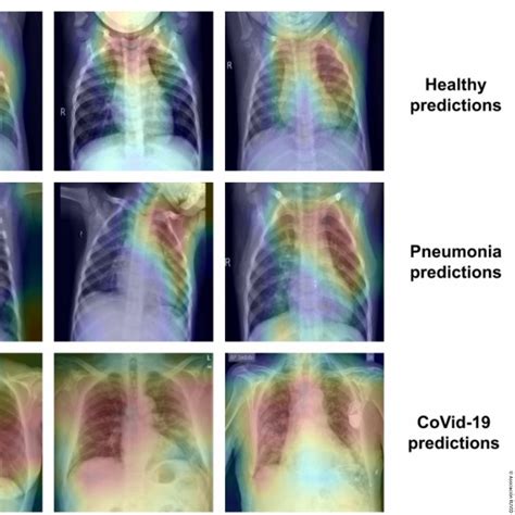 Covid Pneumonia Chest X Ray