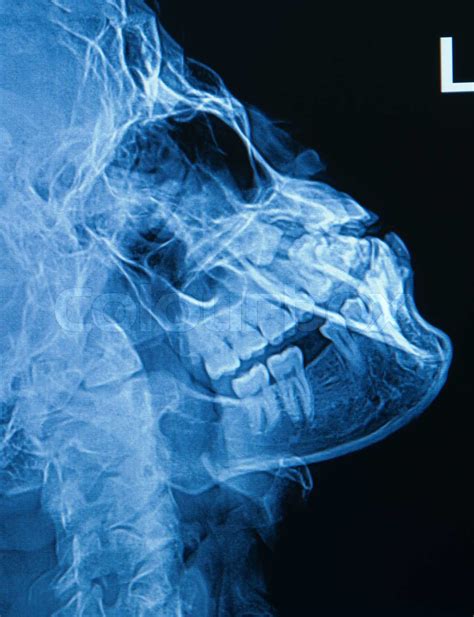 x-ray image of human skull show fracture mandible | Stock image | Colourbox