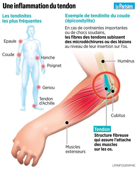 veuf Au nom La relance soigner tendinite au bras humidité Publicité