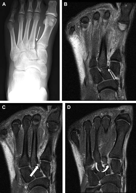 MR Imaging Of The Midfoot Including Chopart And Lisfranc Joint