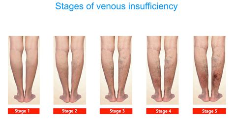 Chronic Venous Insufficiency Cvi Treatments Symptoms Causes Doctor Brace