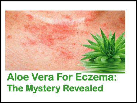 aloe-vera-eczema-1 - Disfreeskin