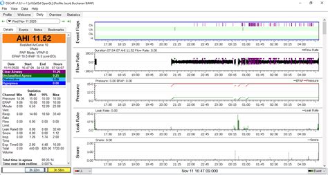 Need Help Understanding BiPAP Clinical Settings | Apnea Board