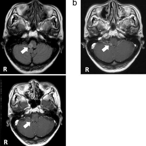 Figure Mri A Flair Imaging At Her First Visit Showing An Abnormal