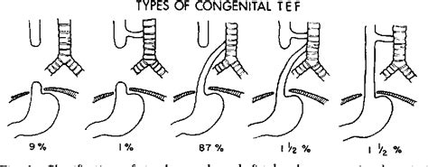 Tracheoesophageal Fistula/Esophageal Atresia Conditions, 58% OFF