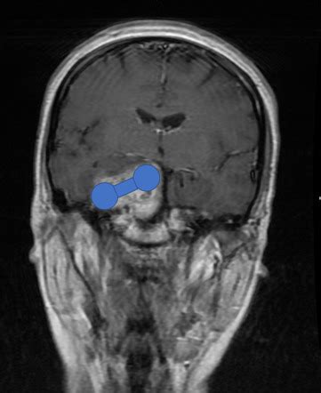 Trigeminal Schwannoma Image Radiopaedia Org