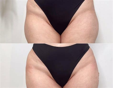 Arquivos harmonização de quadril antes e depois Clínica Fit Body Estética