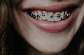 Hot Pink Braces 10 Pros 3 Cons Ultimate Year Guide