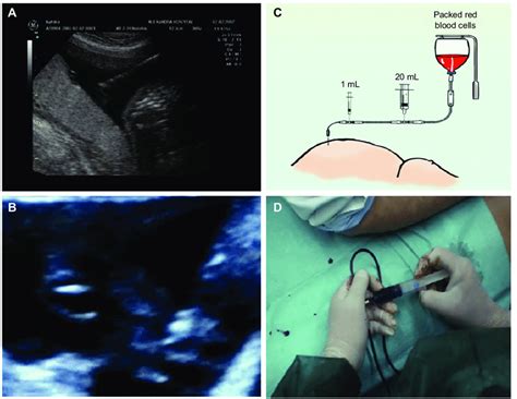 Schematic Presentation Of The Steps Followed In An Iut Procedure A