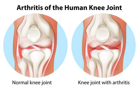 Knee Osteoarthritis – Rupert Health Centre Inc Blog