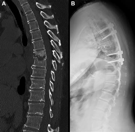 Osteomyelitis X Ray Spine