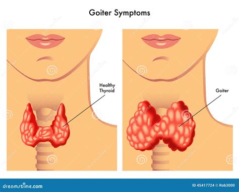 Goiter stock vector. Illustration of enlarged, system - 45417724