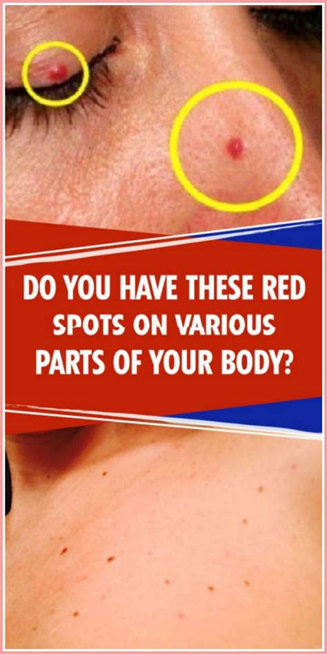 Do You Have These Red Spots On Various Parts Of Your Body Body Body