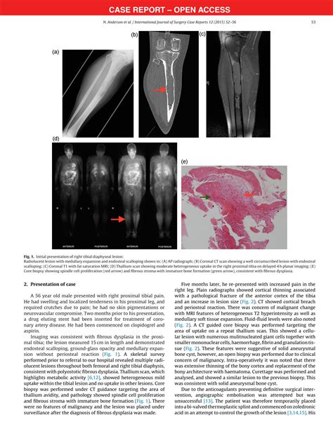 Solution Aggressive Aneurysmal Bone Cyst In Association With