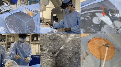 Microwave Ablation Of Hcc Following Transarterial Chemoembolization Download Scientific Diagram