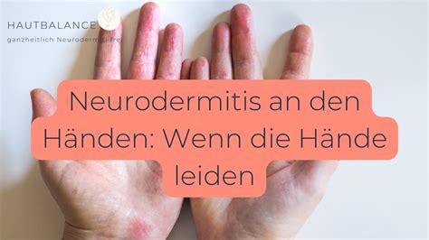 Neurodermitis an den Händen Wenn Hände leiden Folge 65 YouTube