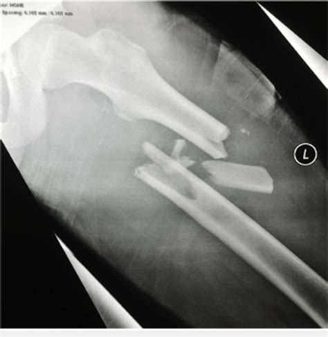 Radiograph Of Left Femur Demonstrating A Comminuted Mid Shaft Fracture