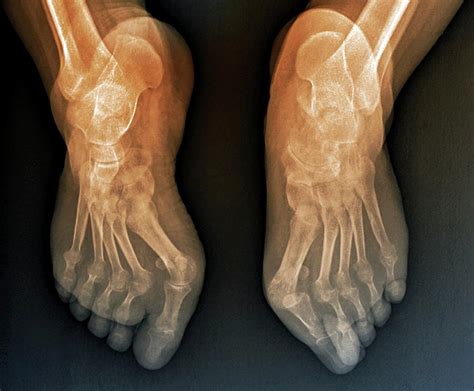 Rheumatoid Arthritis Of The Feet Photograph by Zephyr/science Photo ...