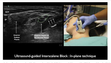 Figure From Sonographic Evaluation Of A Paralyzed Hemidiaphragm From