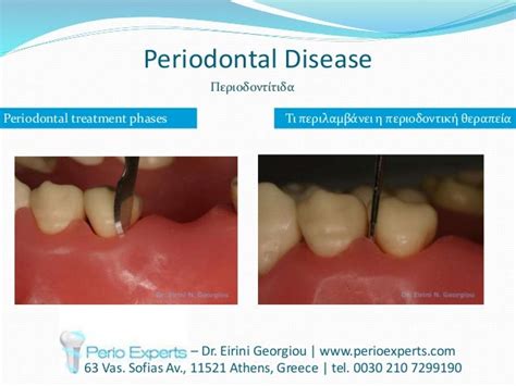 Periodontal Disease Diagnosis Prevention Treatment