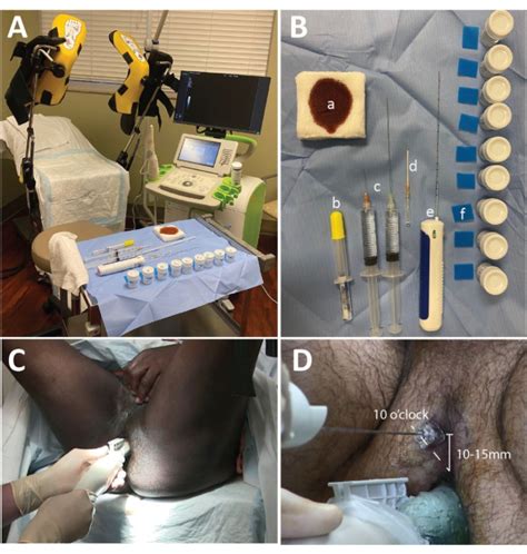 Micro Ultrasound Guided Transperineal Prostate Biopsy A Clinic Based Procedure