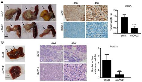 Effects Of Dvl Knockdown On The Proliferation And Metastasis Of Pc