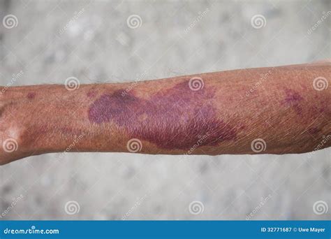 blood spots  skin  arms printable templates protal