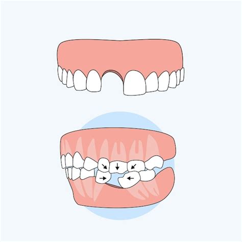 Konsekwencja Niezamocowania Protezy Po Utracie Zęba Premium Wektor
