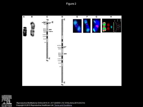 Fish And Array Cgh Characterization Of De Novo Derivative Y Chromosome