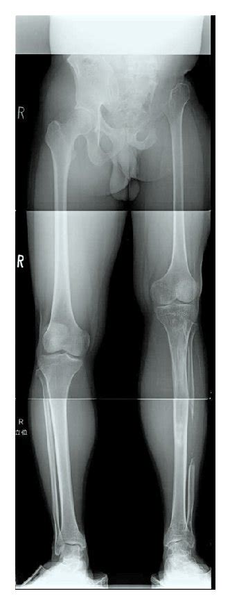 Radiograph Of Entire Lower Limbs At 5 Years After Leg Lengthening