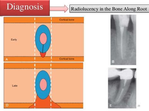 vertical root fracture and it's management .....