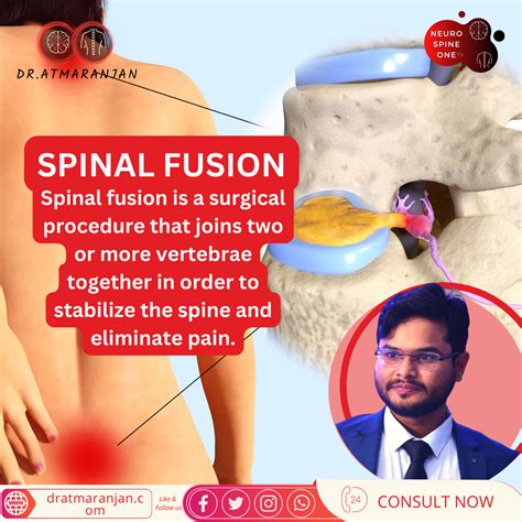 Spinal fusion surgery in Bhubaneswar Consult Now and heal! - Dr. Atmaranjan