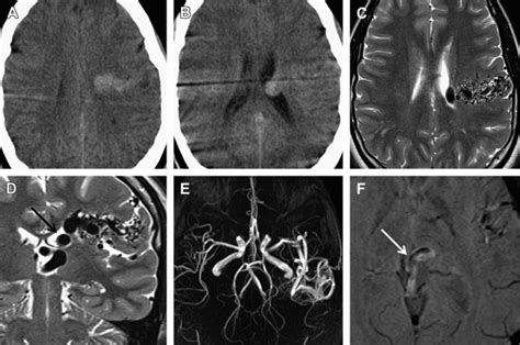 Imaging Of Cerebral Arteriovenous Malformations And Dural Arteriovenous Fistulas Neupsy Key