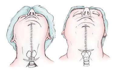 Platysmaplasty Facelift Treatment Management Preoperative Details