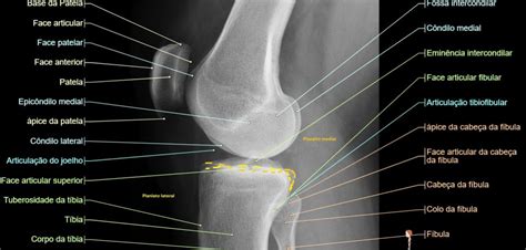 Radiologia Do Joelho Traumatologia E Ortopedia