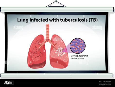 Diagram showing lung cancer illustration Stock Vector Image & Art - Alamy