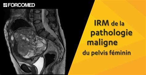 IRM de la pathologie maligne du pelvis féminin FORCOMED