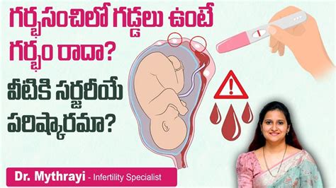 గరభశయల గడడల Pregnancy With Fibroids Uterine Fibroids