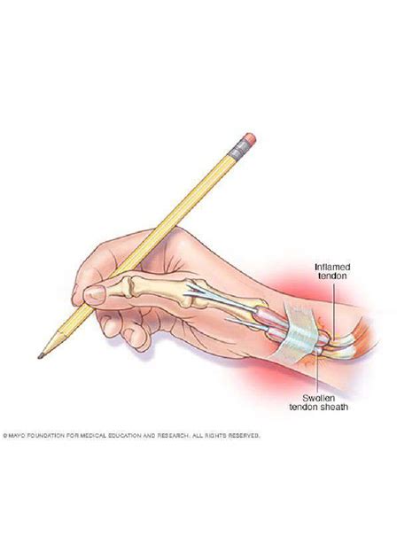 Tenosynovitis Anatomy | PDF