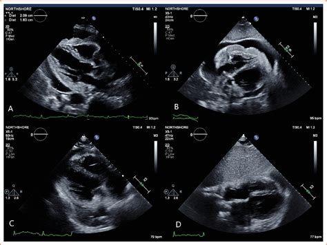 Figure 2 From A Case Of Primary Cardiac B Cell Lymphoma Diagnosed With Cardiac Mri Semantic