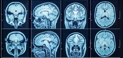 Traumatic Brain Injuries After A Car Accident Signs And Symptoms To