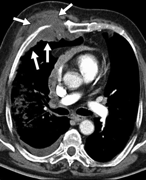 Solid Pleural Lesions Ajr