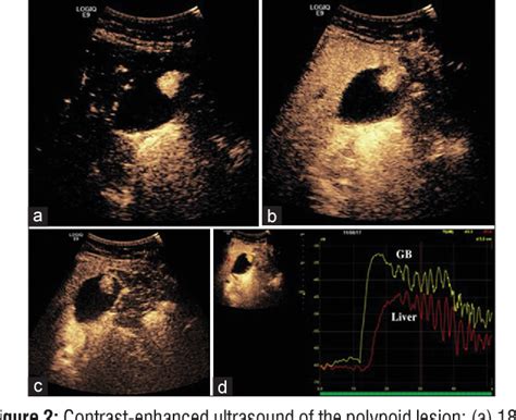 Figure 2 From A Case Of Tubular Adenoma Of Gallbladder Diagnosed Using