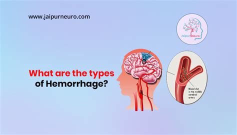 What are the types of hemorrhage? | Dr. Vikram Bohra