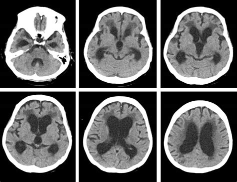 Normal Pressure Hydrocephalus Radiology Cases