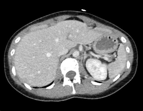 Grade 2 Liver Injury Radiology Case Radshare Net